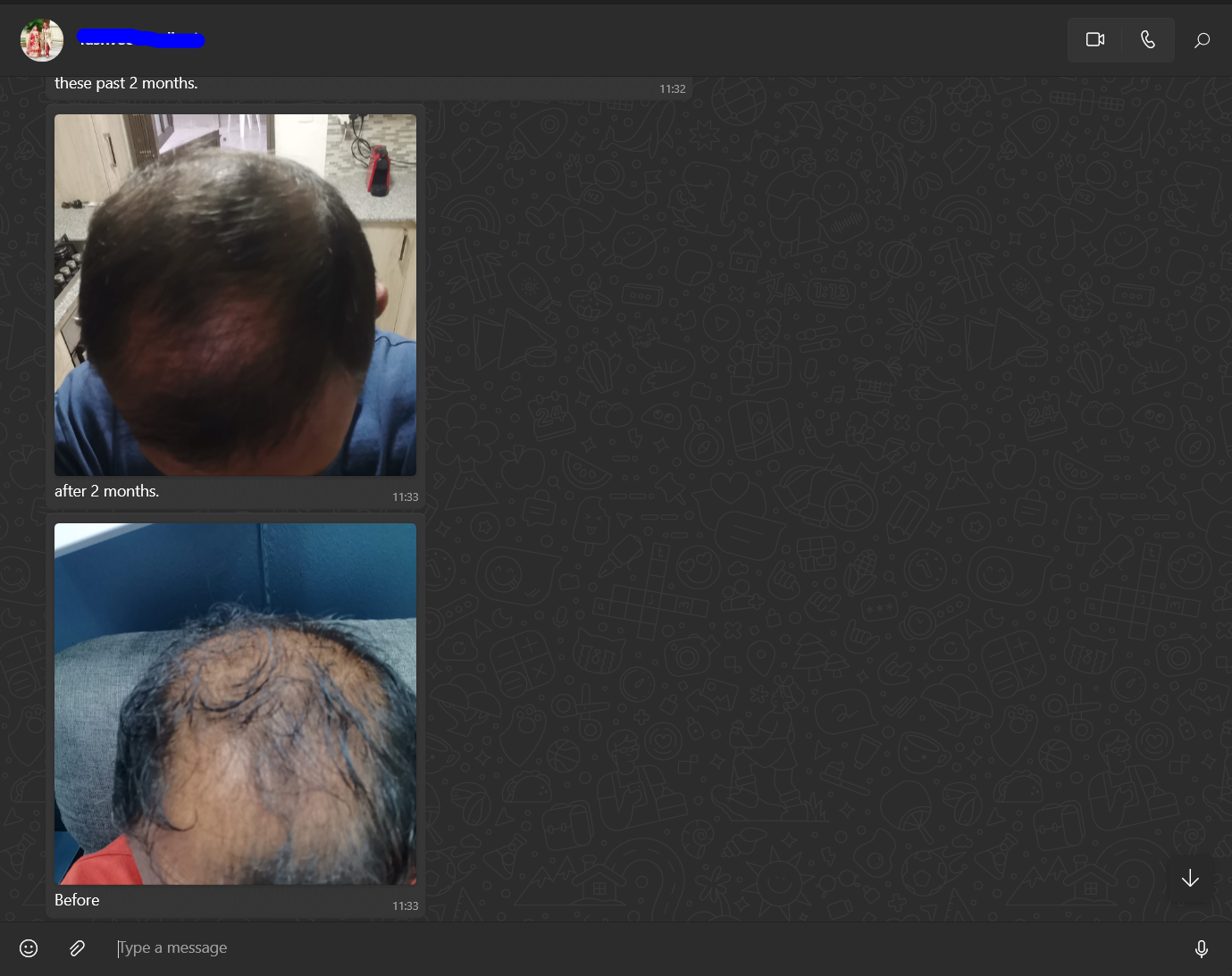 Hair aGain Follicle Revival System
