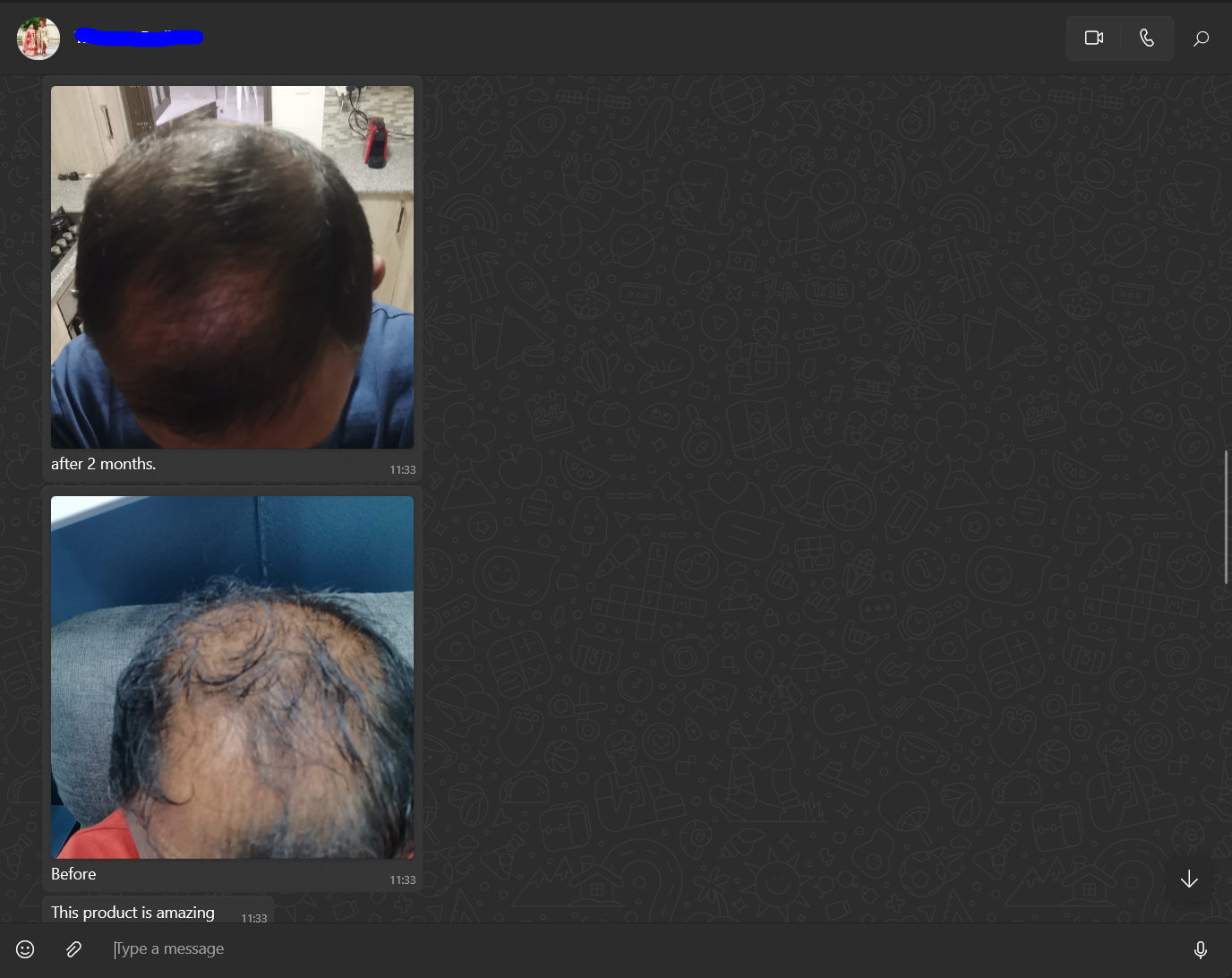 Hair aGain Follicle Revival System